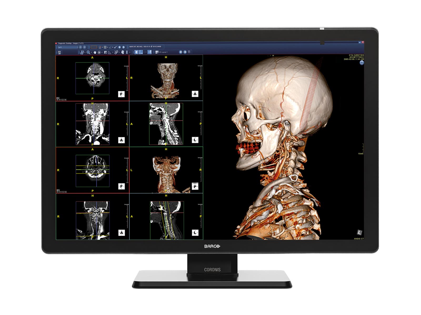 Barco Coronis Fusion MDCC-6530 6MP 30" Color Medical Diagnostic Radiology Monitor (Copy) Monitors.com 